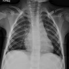 NCCT Clavicular Joint