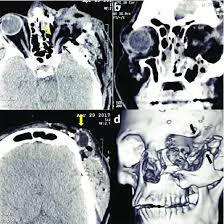 NCCT Face Coronal