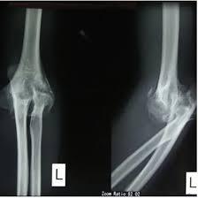NCCT Left Elbow