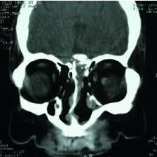 NCCT-PNS-Sagittal