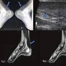 NCCT Right Ankle Joint
