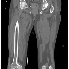 NCCT Right Leg
