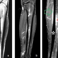 NCCT Right Tibia