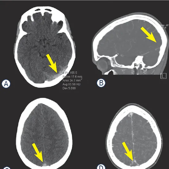 NCCT Scrotum