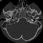 NCCT Temporal Axial and Coronal