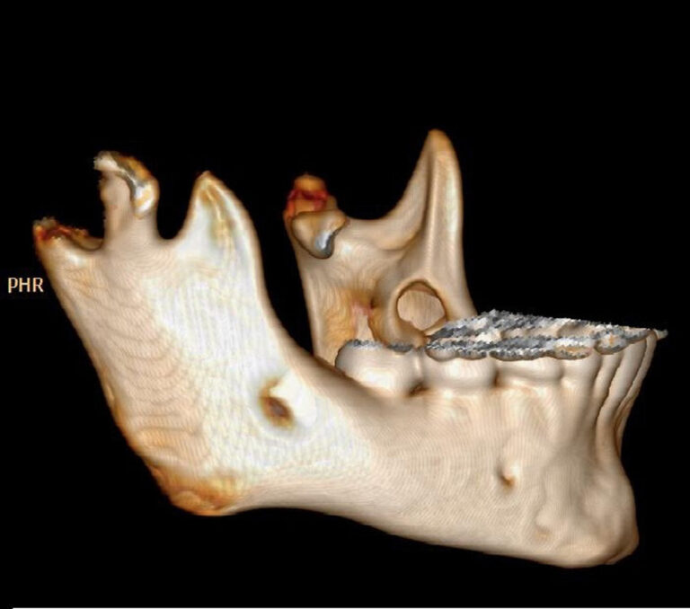 3D CT Mandible