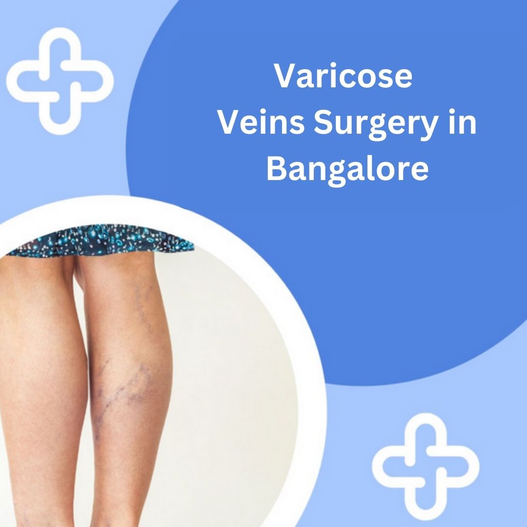 Varicose Veins Surgery in Bangalore
