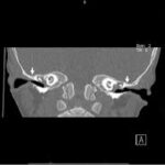 CT Inner Ear Coronal