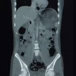 CECT Lower Abdomen