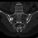 CT Scan Bilateral Sacroiliac Joint