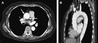 CT Aortic Angiography