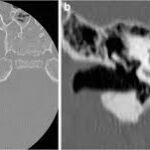 CT Inner Ear Axial