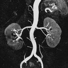 MR Angiography of the Renal Arteries with Contrast
