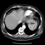Triple Phase CT Abdomen