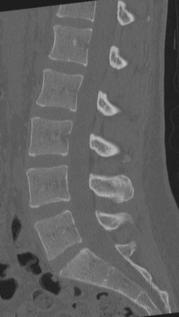 CT Spine With Contrast