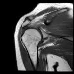 MRI Bilateral Shoulder