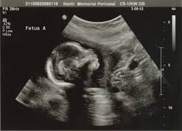 Level 2 Ultrasound in Pregnancy