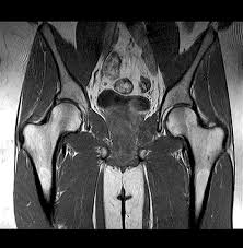 MRI Screening of Left HIP