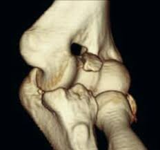 3D CT Right Elbow scan.