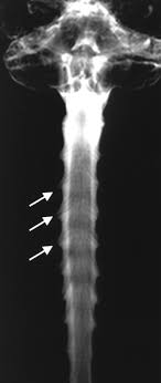 MRI Spine With MR Myelography