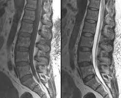 MRI Sacral Spine