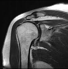 MRI of the Left Shoulder