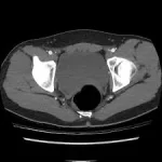 CT Angiography Pelvis