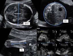 Fetal Well-Being Ultrasound