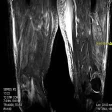 MRI Screening for Left Thigh