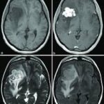 MRI Brain With Contrast