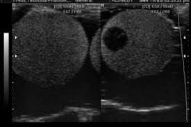 Ultrasound Scrotal