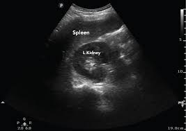 Lower Abdomen Ultrasound