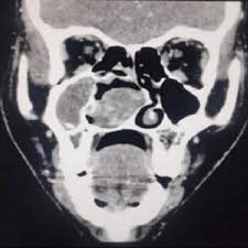 CECT PNS Axial/Coronal