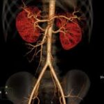 CT Mesenteric Angiography