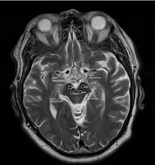 MRI Area Of Interest