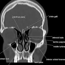 CECT PNS Axial and Coronal Scan