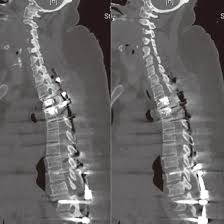 NCCT Lumbar Spine