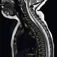 NCCT Neck Extended