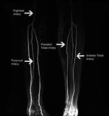 MR Angiography Left Leg