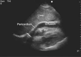 Ultrasound Pericardial Effusion