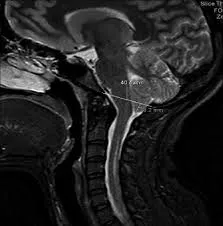 MRI CV Junction and Cervical Spine