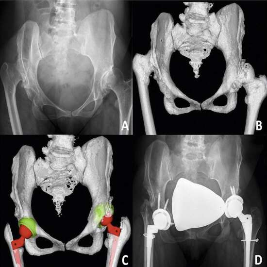 CT Hip Joints