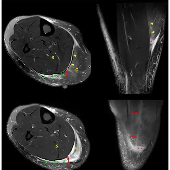 MRI Right Calf