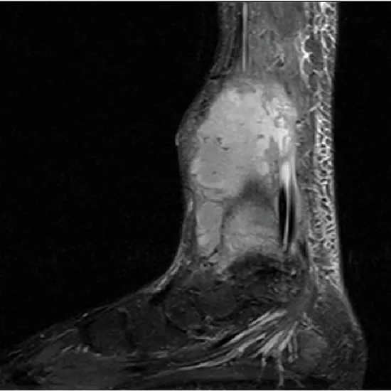 mri-left-tibia
