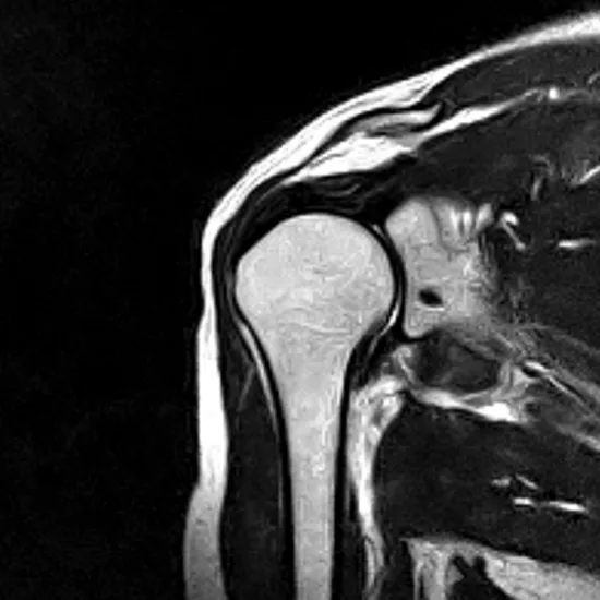 MRI Left Shoulder With Contrast