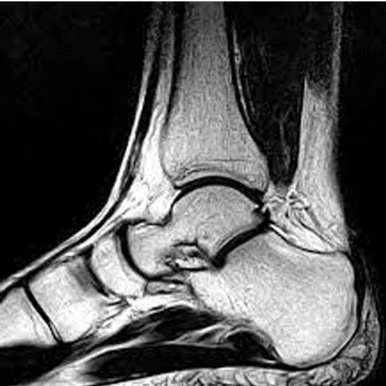 MRI Left Ankle Joint