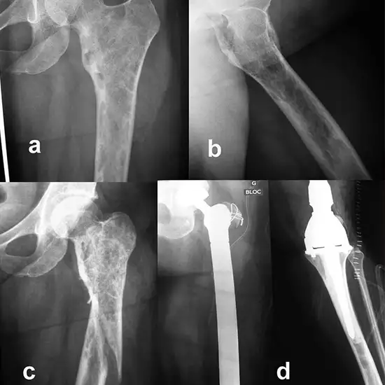 X-Ray Right Hip with Thigh Lateral View