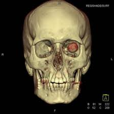 3D CT Face