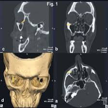 3D CT Orbit