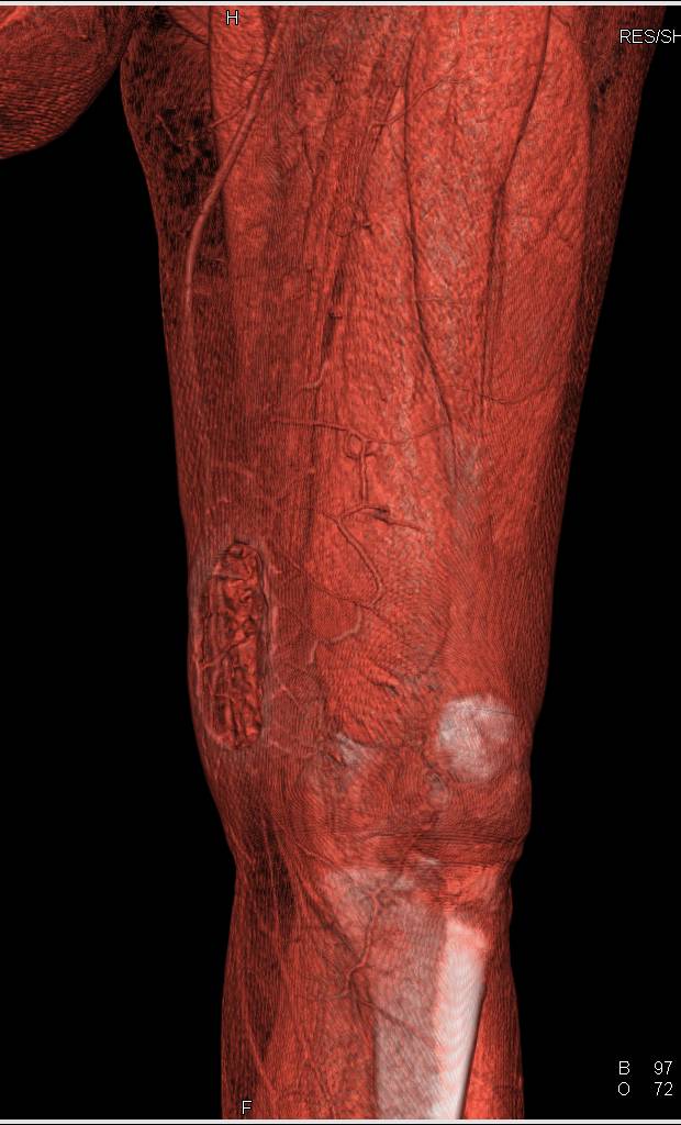 3D CT Thigh